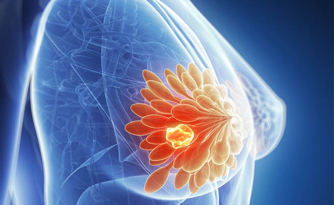  Cancerul mamar - factori de risc, diagnostic, tratament